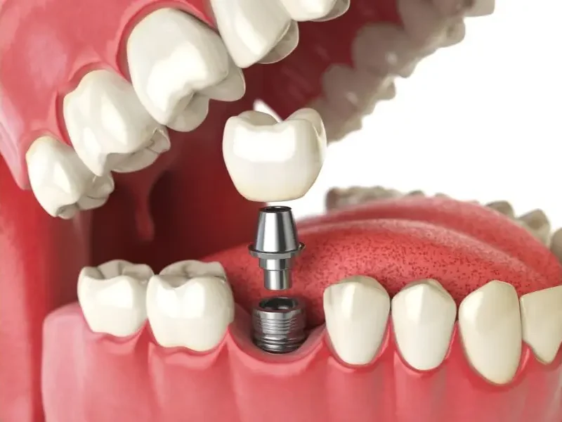 dental bridge vs implant Wellington