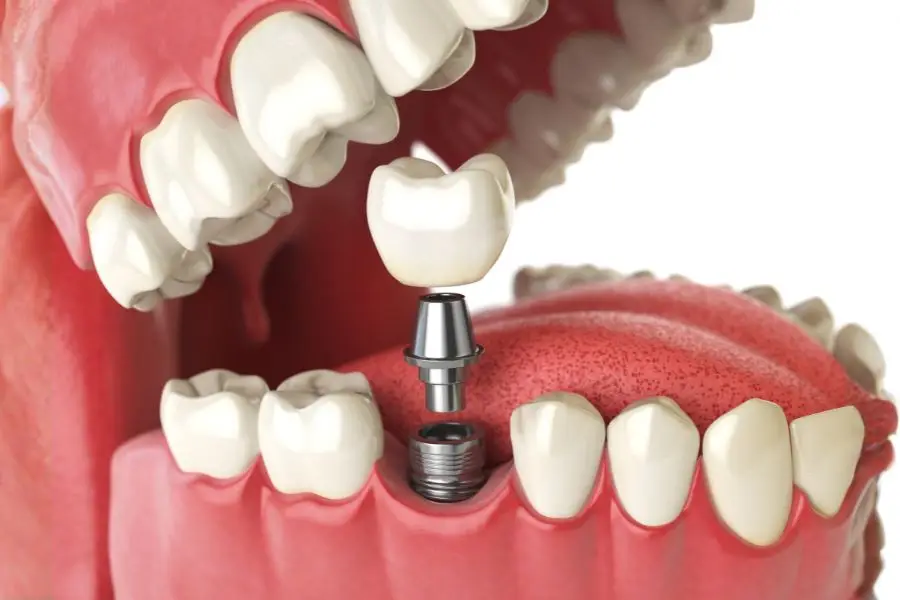 dental bridge vs implant Wellington