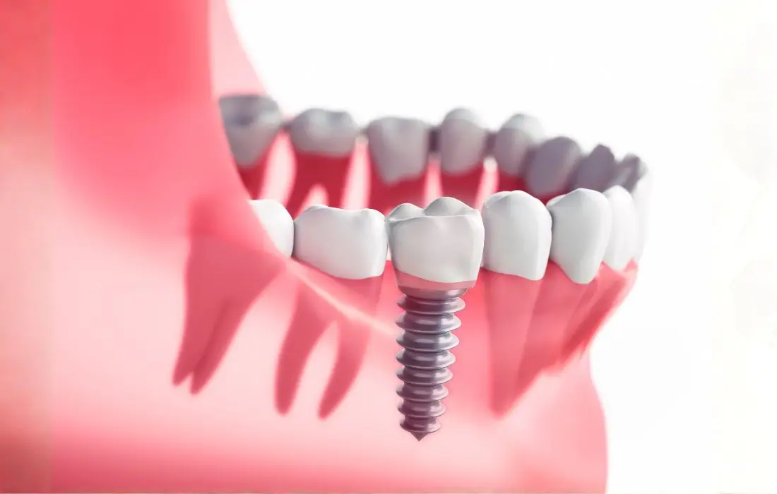 dental implant healing time