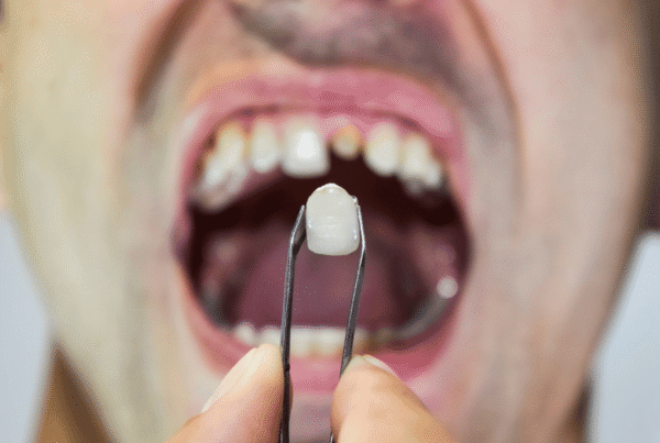 tooth replacement options Wellington