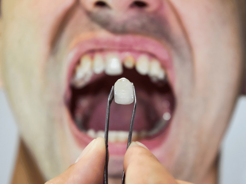 tooth replacement options Wellington